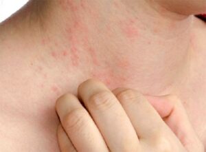 DR SANTIAGO RIOLFO: BROTES Y ENFERMEDADES DE LA PIEL