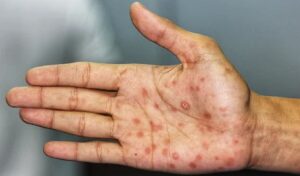 ENFERMEDADES DE TRANSMISIÓN SEXUAL: AUMENTO DEL 70% EN SÓLO UN AÑO